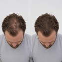 Fibras Capilares by AGV para Disimular Calvicie – 22g | Volumen Instantáneo